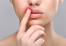 Herpes labial